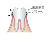 歯周病初期段階