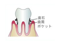 歯周病中程度