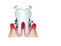 歯周病が深刻に進行した段階