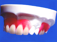 ナチュラルデンチャーとは