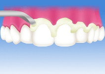 ペーストを塗布