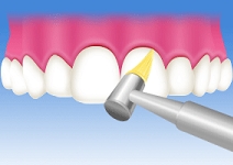 歯と歯の隙間を清掃