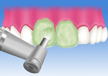 歯面のクリーニング